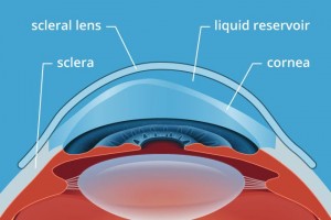 Scleral Lenses